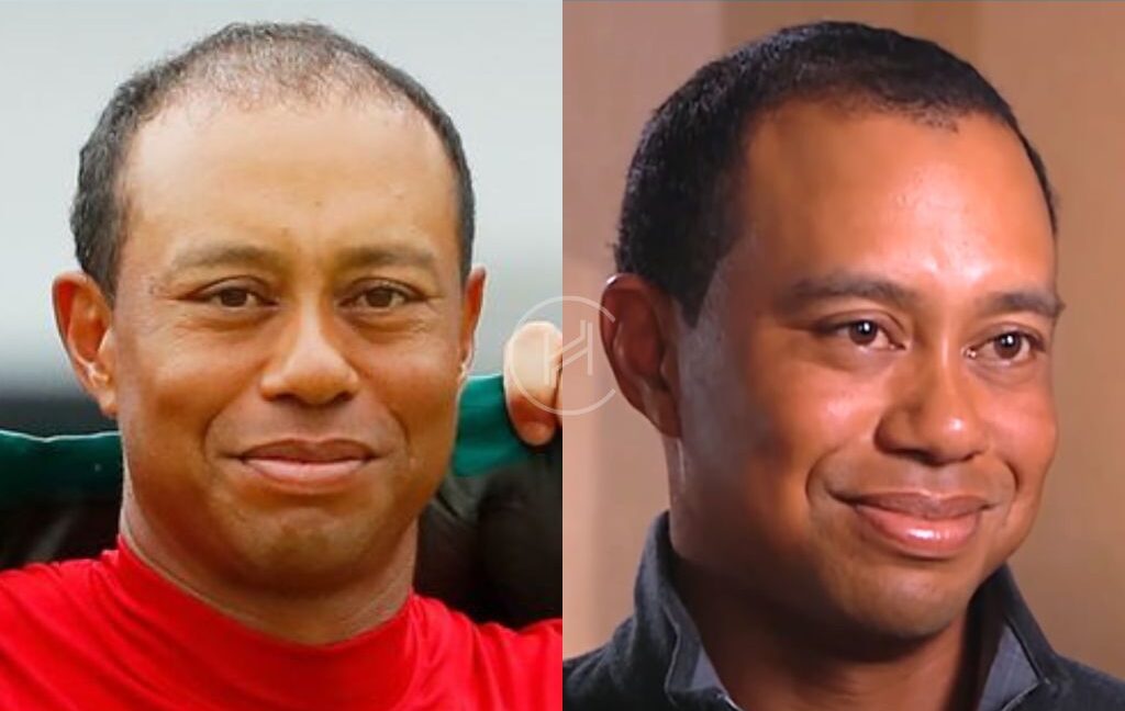 tiger woods hair transplant